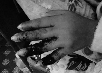 हटब्याग पग्लिएर इटहरीकी किशोरीको शरीर जल्यो, सहयोगको अपिल