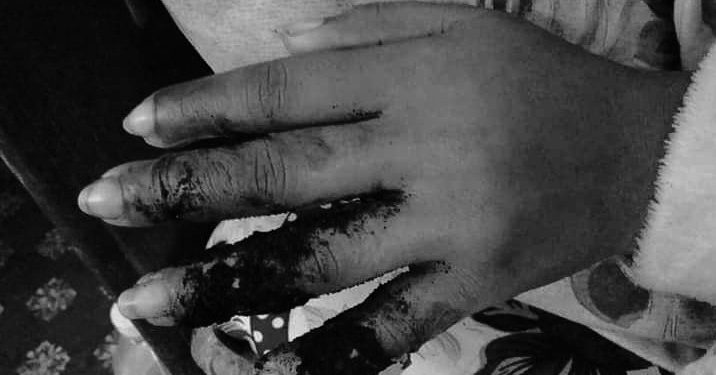 हटब्याग पग्लिएर इटहरीकी किशोरीको शरीर जल्यो, सहयोगको अपिल