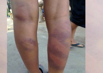 झापा : फेसबुकमा कमेन्ट गरेको निहुँमा प्रधानाध्यापकले कुटे विद्यार्थी