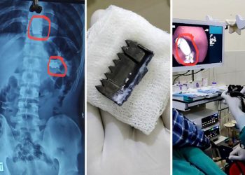 २१ वर्षीय युवकले आत्महत्याको प्रयास गर्दा पेटीको ‘बक्कल’ र घाँटीमा लगाएको सिक्री निले