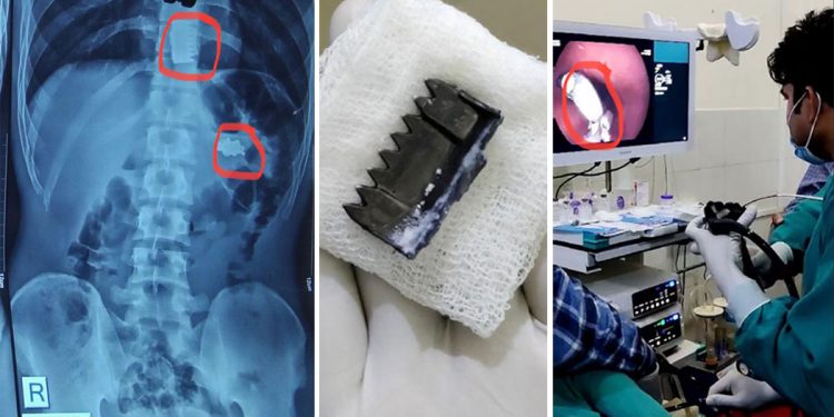 २१ वर्षीय युवकले आत्महत्याको प्रयास गर्दा पेटीको ‘बक्कल’ र घाँटीमा लगाएको सिक्री निले