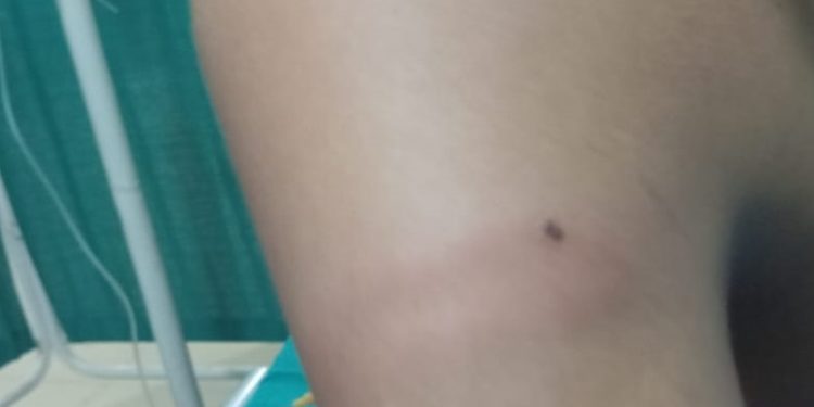 मोरङमा शिक्षकले कुटपिट गर्दा विद्यार्थी घाइते